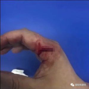 空手夺刀肌腱断裂，其实防割手套就揣在屁股后头